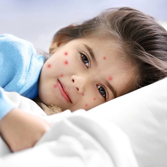 Chickenpox
