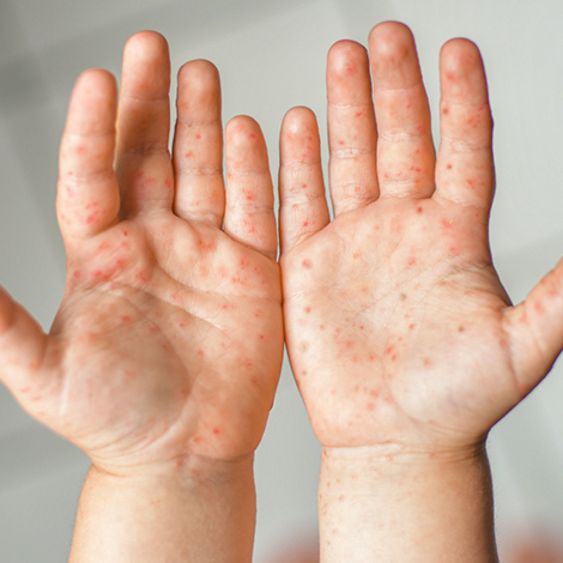 Hand, Foot & Mouth Disease (HFMD)