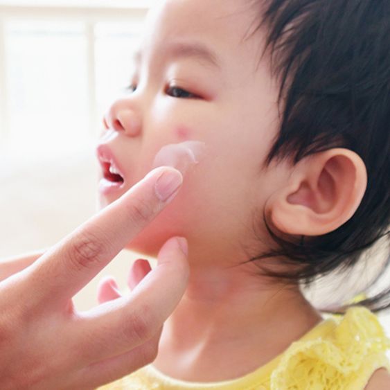 Eczema (Dermatitis)