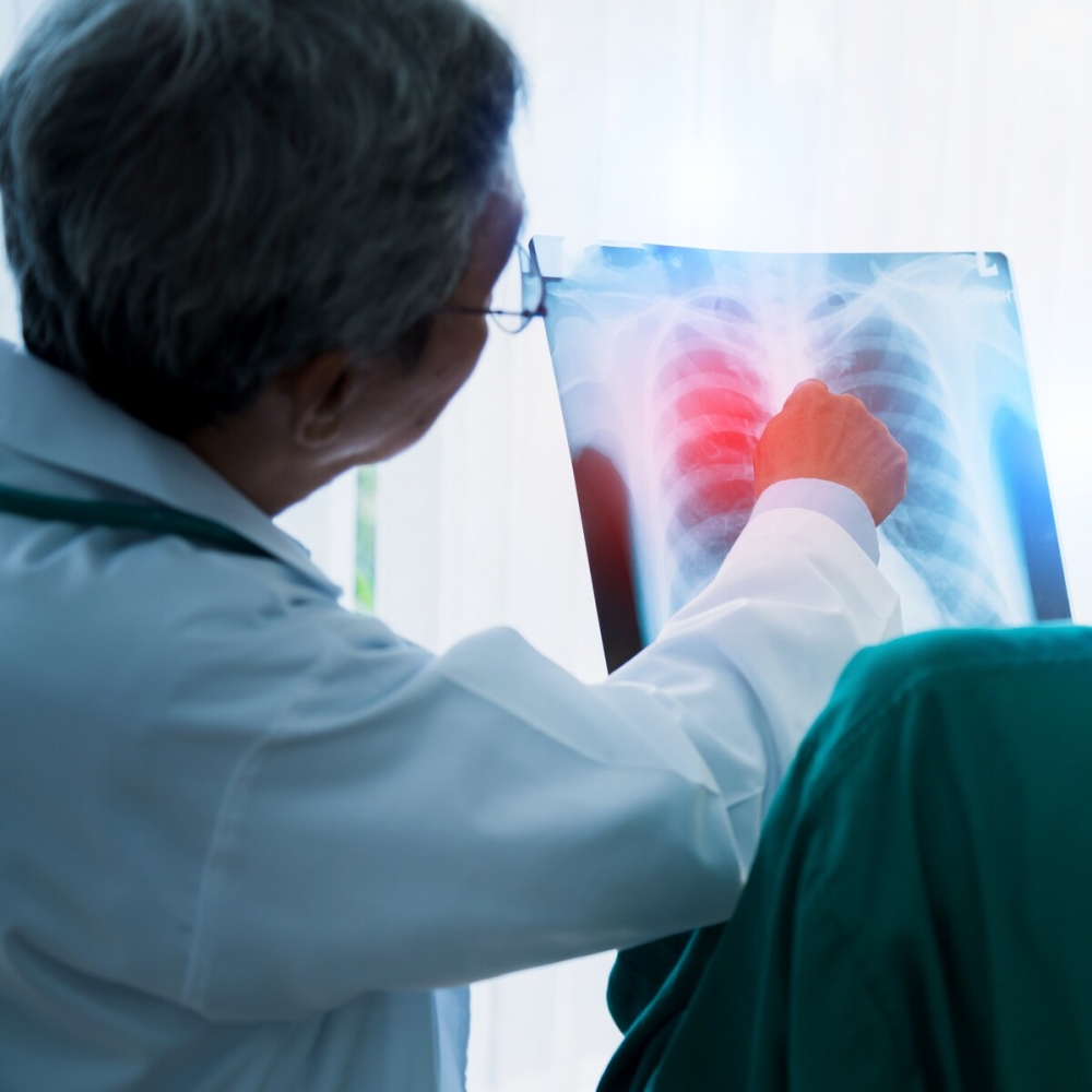 Lung Cancer Diagnosis and Treatment