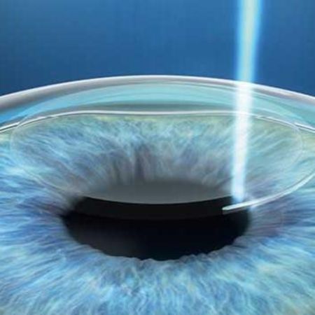ZEISS SMILE® pro 2.0